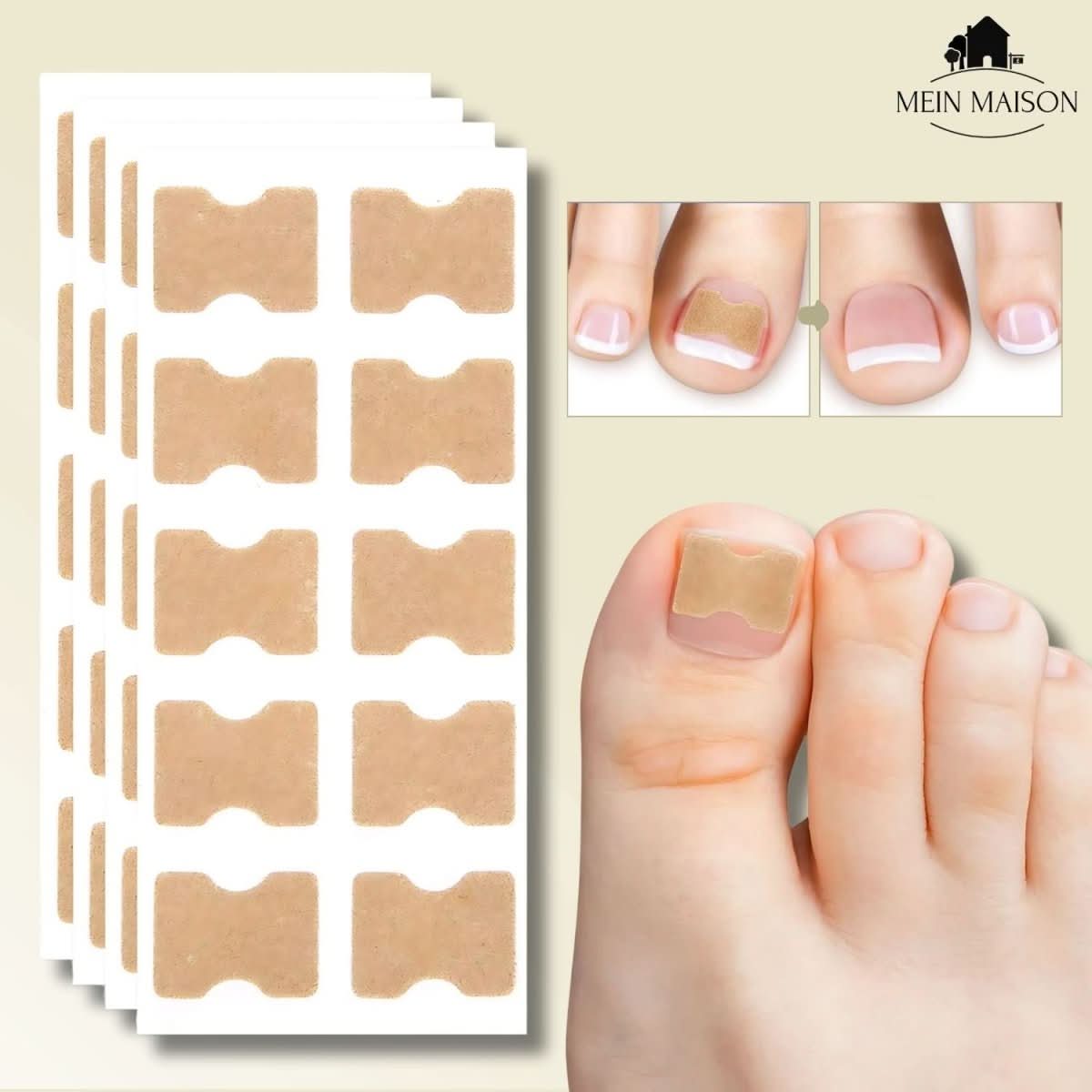 FixaNail - Gentle nail correction against ingrown nails & pain