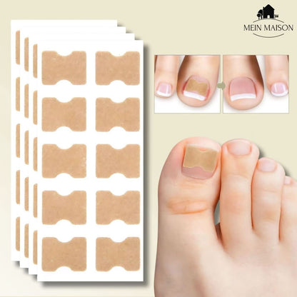 FixaNail - Gentle nail correction against ingrown nails & pain