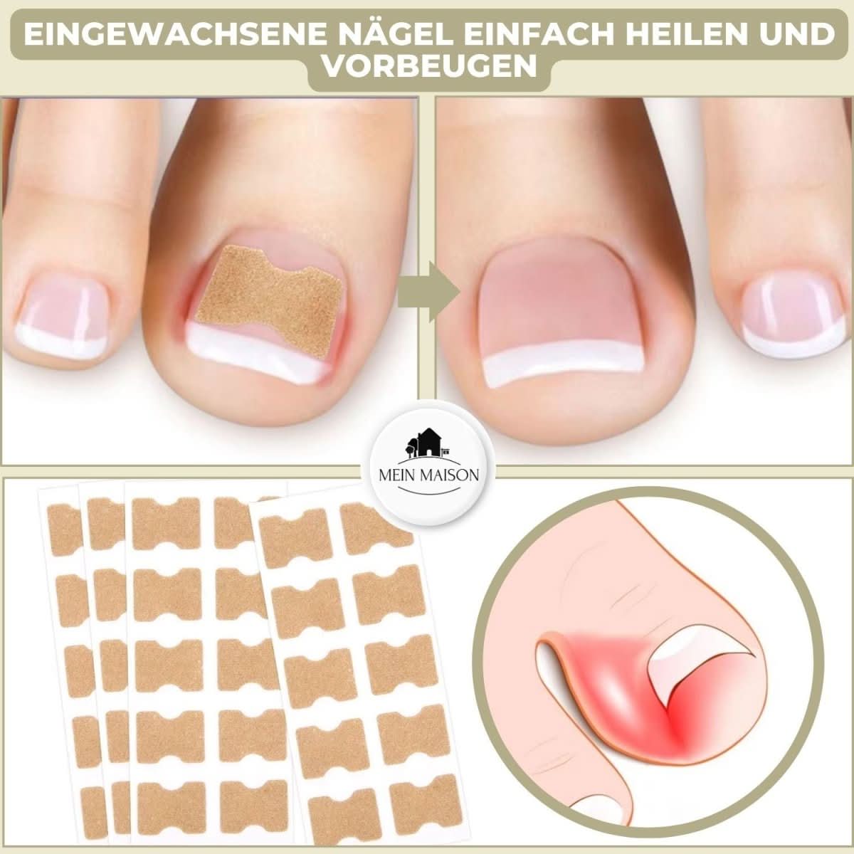FixaNail - Gentle nail correction against ingrown nails & pain