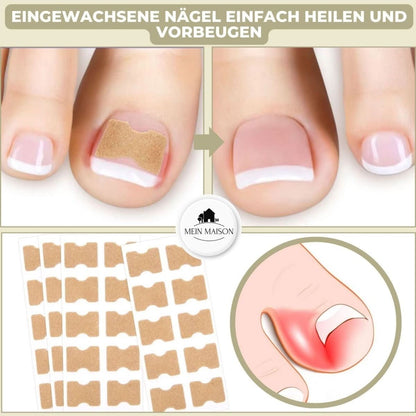 FixaNail - Gentle nail correction against ingrown nails & pain