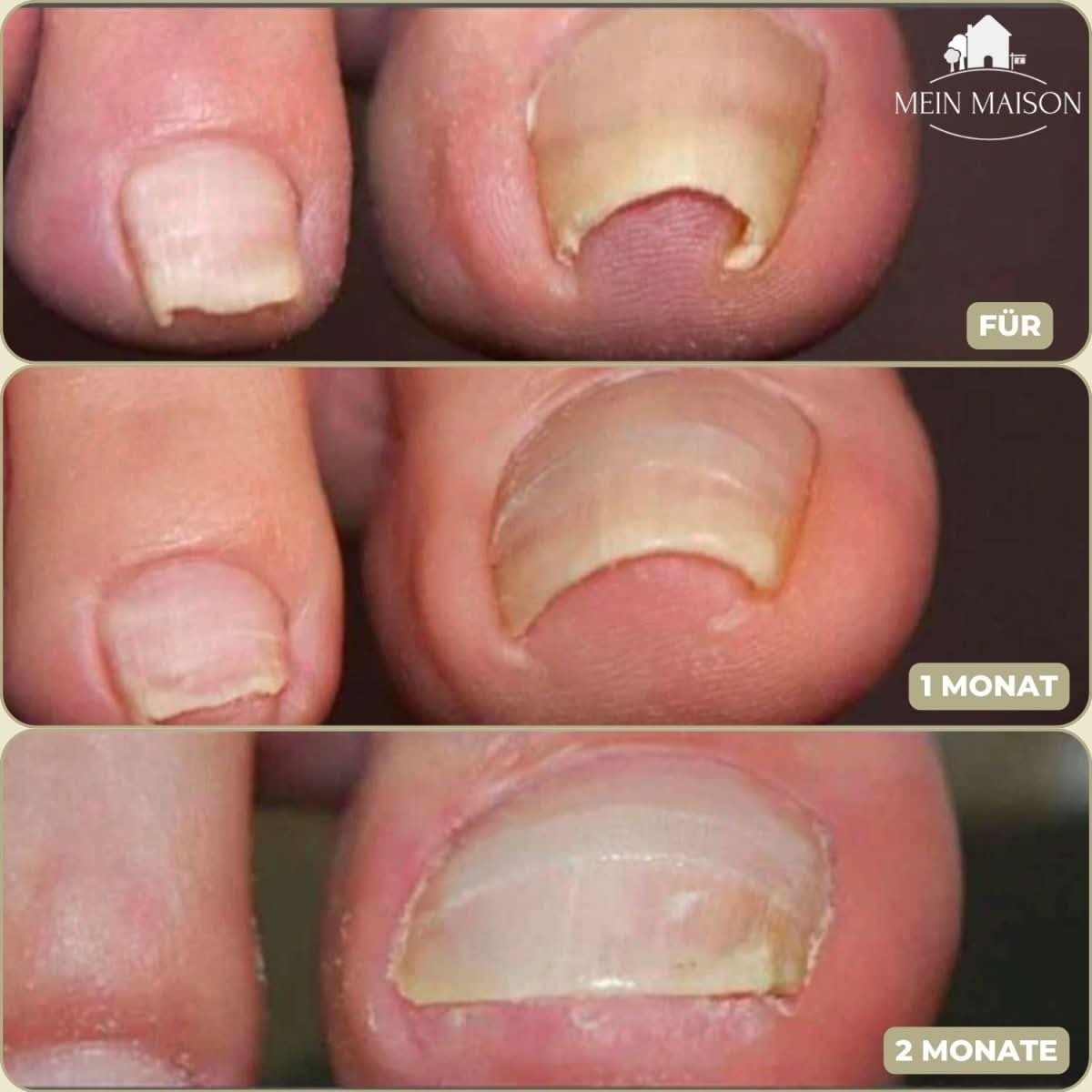 FixaNail - Gentle nail correction against ingrown nails & pain