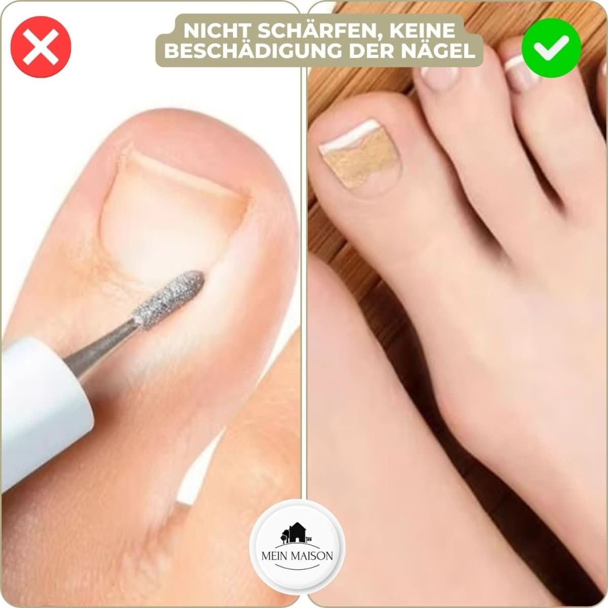 FixaNail - Gentle nail correction against ingrown nails & pain