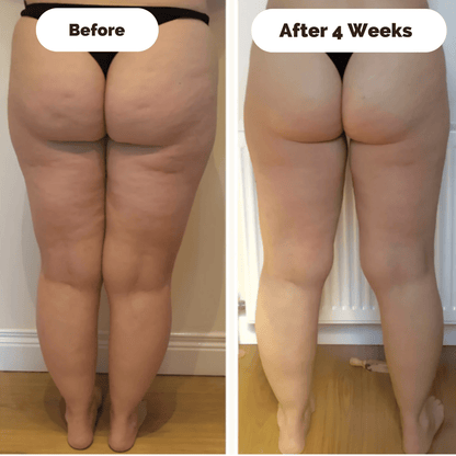SKINLIFT – Skin Firming Massage Device against Cellulite