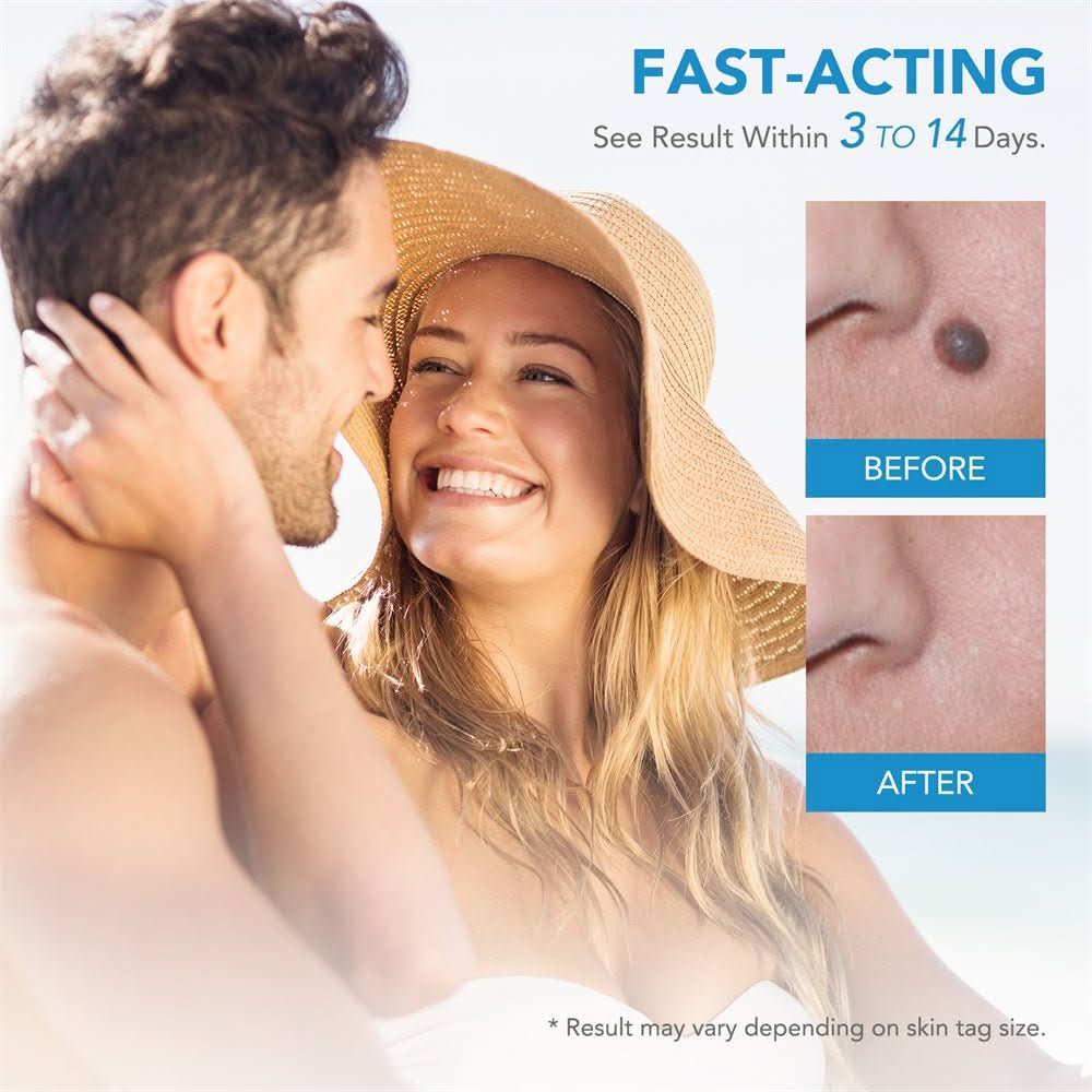 SpotOff Skin Tag Remover - Painless skin tag removal for neck, back & body