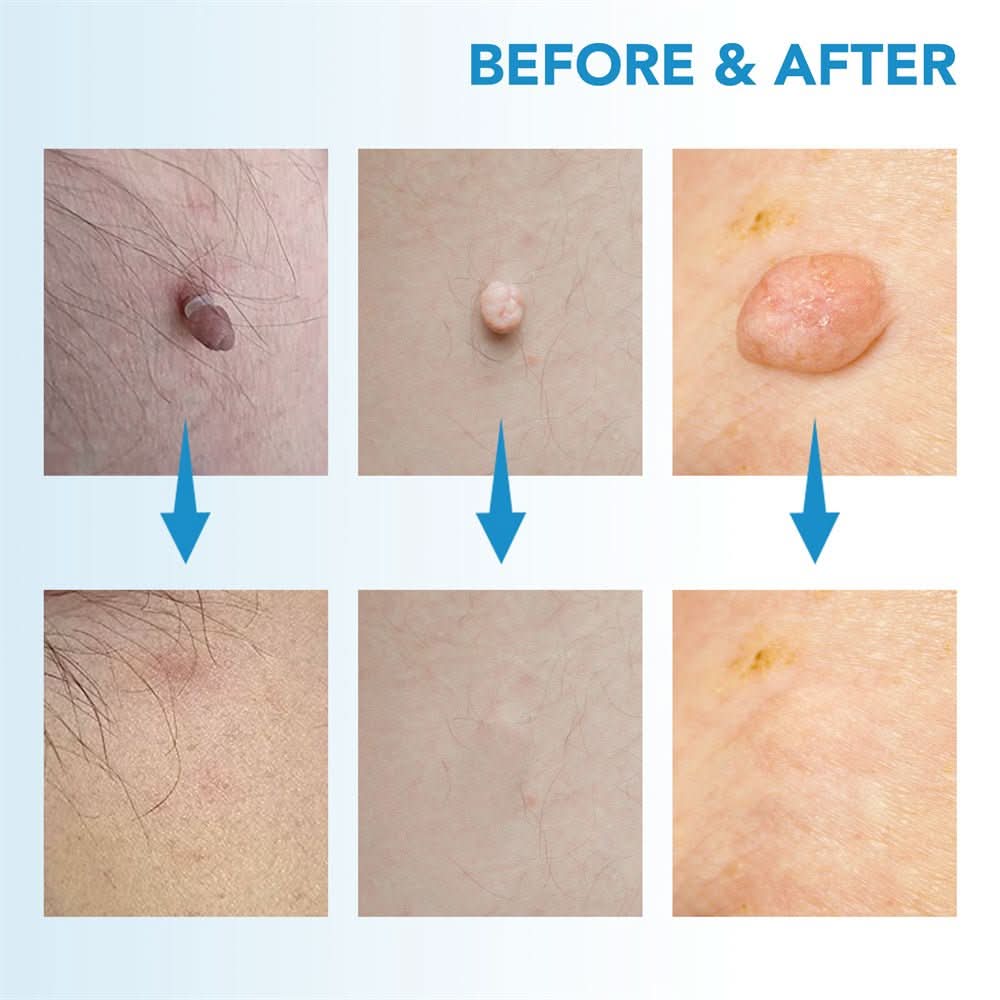SpotOff Skin Tag Remover - Painless skin tag removal for neck, back & body