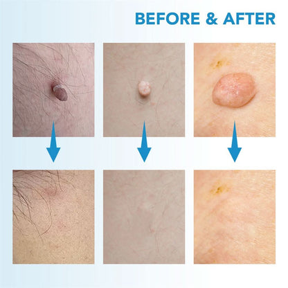 SpotOff Skin Tag Remover - Painless skin tag removal for neck, back & body